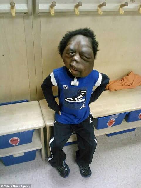 Amare Was Born With One Of The Strangest Deformities In History